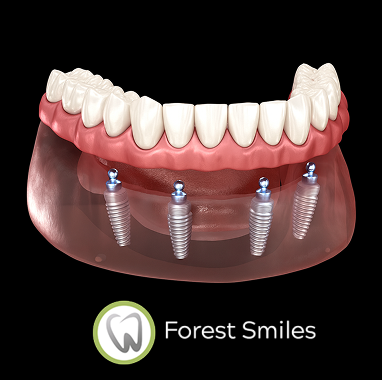 Snap-On Implant Dentures